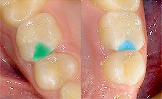 Цветные пломбы - детская стоматология