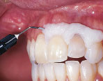 Отбеливание зубов за одно посещение