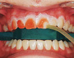 Отбеливание зубов со скидкой